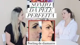 PEELING DE DIAMANTE - ANTES E DEPOIS