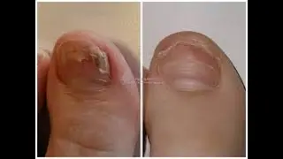 How to get rid of nail fungus forever  #Folk Methods #Nail Health
