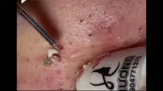 1 ❗❗❗ВНИМАНИЕ❗❗❗ЧЕРНЫЕ ТОЧКИ/ЖИРНАЯ КОЖА/ЧИСТКАЛИЦА