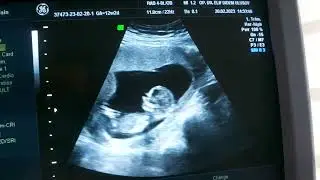 12 hafta gebelik izlemi ultrason görüntüsü