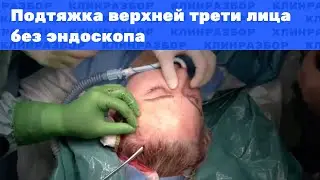 Операция: Подтяжка верхней трети лица без эндоскопа