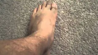 Massage for Plantar Fascitis