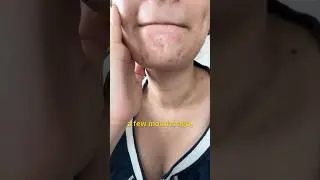 My Acne Journey & Treatment