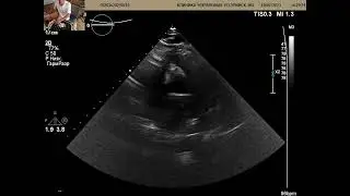 Heart ultrasound. 26 year old girl.