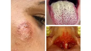 ASMR Face And Mouth Inside Injury Treatment 