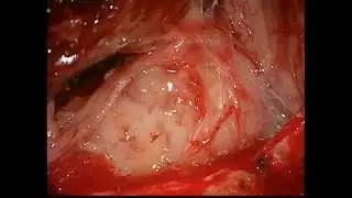 Surgical management of meningioma of the craniovertebral junction operated by Prof Dr Selçuk YILMAZL