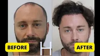 Hairtransplant Turkey RESULT! AMAZING