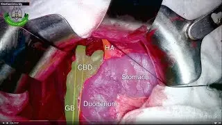 Bile duct resection and hepaticojejunostomy of Choledochal cyst type I