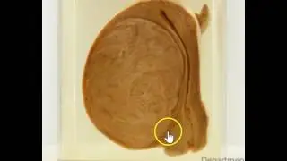 Uterus leiomyoma: Gross pathology