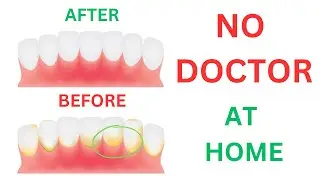 Plaque Attack: DIY Tooth Plaque Removal