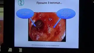 Бронхо 30 09 Гринкевич МВ EBUS ассист реканализация анастомоза правого главного бронха