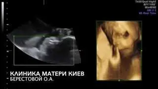 ЭТО ВИДНО НА УЗИ! Когда начинает формироваться сосательный рефлекс?