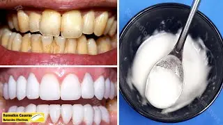 Cómo Blanquear Los Dientes En 3 Minutos || Convertir Los Dientes Amarillos En Blancos Naturalmente