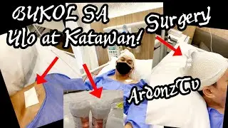 #BUKOL SA ULO AT KATAWAN #SALAMAT DOC FOR THE SUCCESSFUL SURGERY