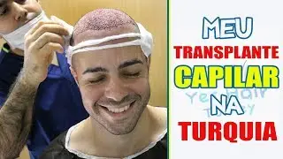 MEU TRANSPLANTE CAPILAR NA TURQUIA