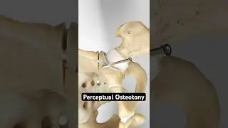 Securing a shallow hip socket (3D Animation)