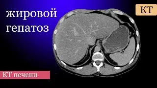 Radiological diagnostics of fatty liver