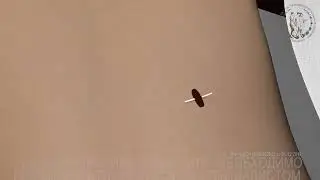 Операция по формированию узкой талии