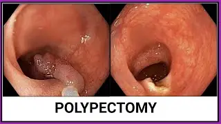 POLYPECTOMY !! পলিপেকটমি #BD_ENDOSCOPY