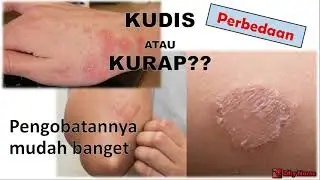 WAJIB TAU !!! KUDIS atau KURAP ? Perbedaan dan Cara Mengobatinya