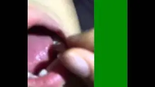 răng Ben sâu 4 tuổi