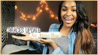 NO MORE GAP! (Braces Update)