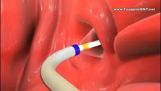 Balloon Eustachian Tube Dilation to Treat Eustachian Tube Dysfunction