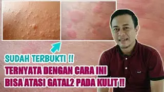 Cara Mengatasi Gatal Gatal Pada Kulit, 100% Sudah Terbukti !!