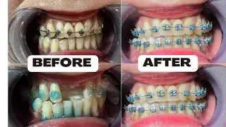 UPPER &  LOWER METALLIC BRACE WITH DENTURE #braces#installation