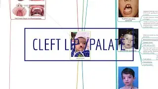 CLEFT LIP/PALATE