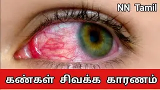 கண்கள் அடிக்கடி சிவந்து போவதற்கு காரணம் | Red Eyes Causes and Treatment | NN Tamil