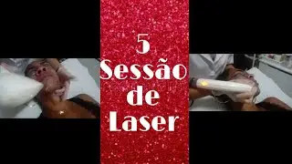 Parte2: 5 Sessão a Laser Light Sheer