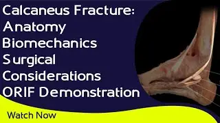 Calcaneus Fracture: Anatomy | Biomechanics | Surgical Considerations |  ORIF Demonstration