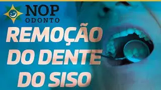 remoção do Dente do Siso