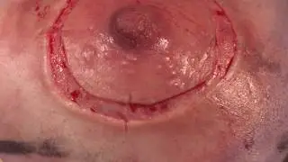 Vertical Mastopexy