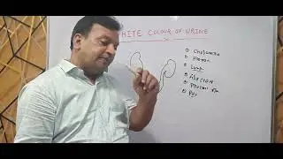 CHYLURIA, SYMPTOMS, TREATMENT.(CHYLURIA का ईलाज बिना OPERATiON के) # Dr Deepak Prasad singh