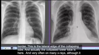 Chest  x-ray,  Left lower lobe collapse - CT chest lower lobe collapse