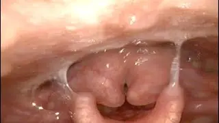 Ларингомаляция I типа / Type I Laryngomalacia