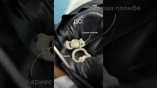 Замена старой пломбы🔥 