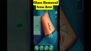 3D Animation of Glass Removal from Arm. 