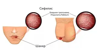 Алокаи чинси ва бемории Сифилис.