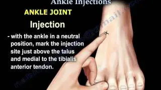 Common Foot And Ankle Injections - Everything You Need To Know - Dr. Nabil Ebraheim