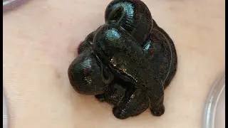 Можно ли ставить пиявки при диабете?