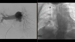 Case Discussion: IR Catheter Directed Thrombolysis For High PE Burden