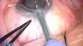 Wound Burn Phaco 3.1 Complications