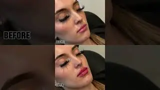 Lip Filler Results