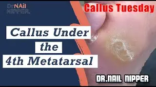 Callus Under the 4th Metatarsal. What is Neuropathy?  [Callus Tuesday] (2020)