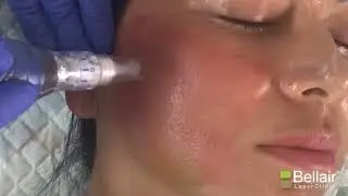 Anti-Aging Treatments At Bellair Laser Clinic