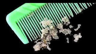 ¿ Que Origina La Caspa ? y Como Acabar Con La Caspa