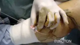 Phlebology - Endoperivenous Laser Treatment on Collaterals - Trattamento Endoperivenoso Collaterali